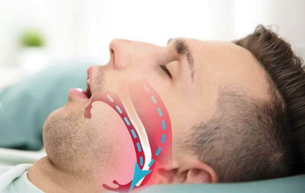Ngủ ngáy là một tình trạng phổ biến