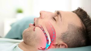 Ngủ ngáy là một tình trạng phổ biến