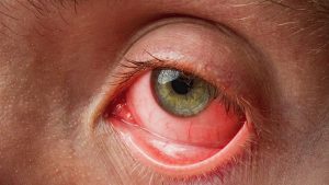 Nhìn vào mắt người đau mắt đỏ có bị lây không
