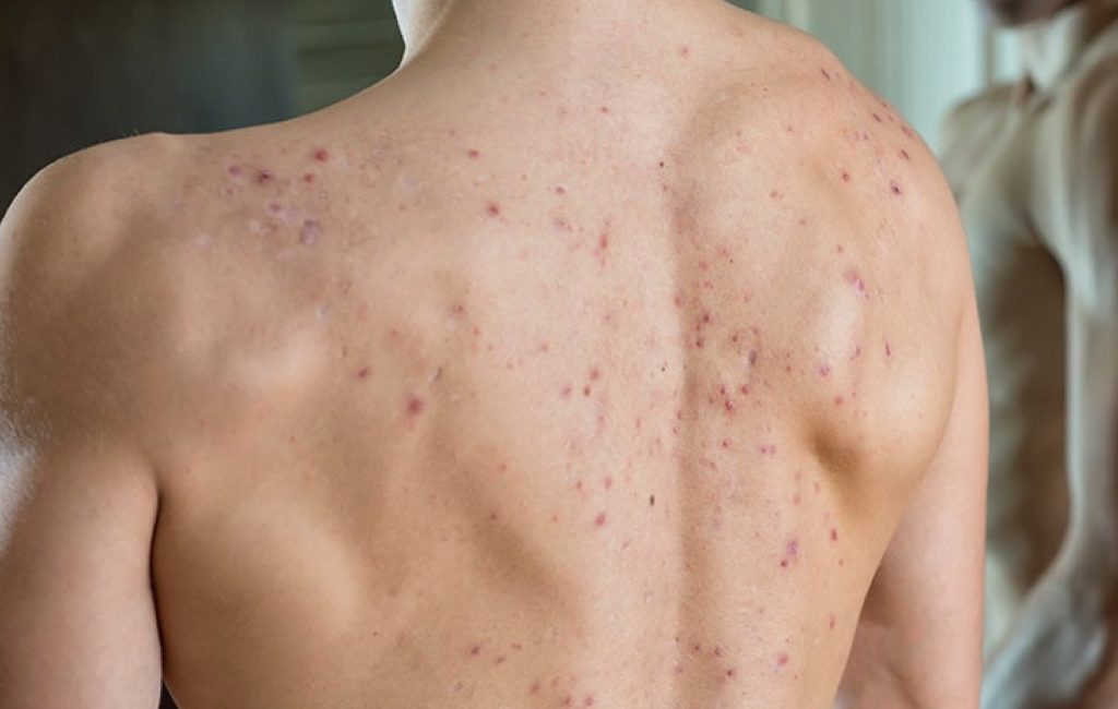 Trị mụn lưng hiệu quả tại nhà