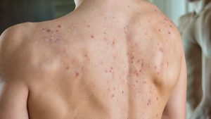 Trị mụn lưng tại nhà