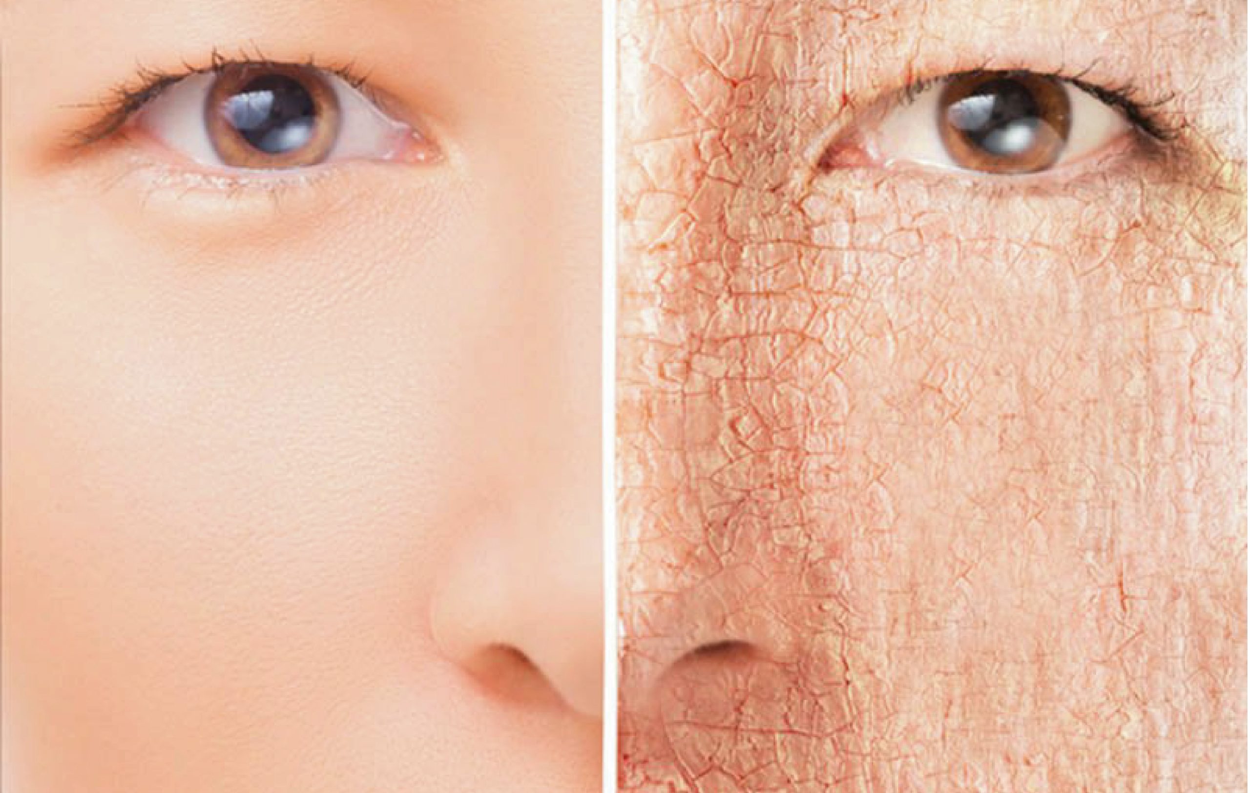 Cơ thể bị mất nước khiến da khô
