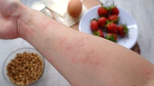 Dị ứng thực phẩm nổi mẫn đỏ